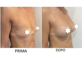 Mastoplastica additiva prima e dopo