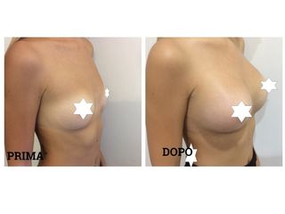 Mastoplastica additiva pre e post
