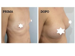 Mastoplastica di aumento prima e dopo