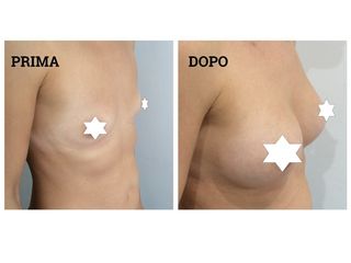 Mastoplastica additiva prima vs dopo