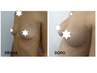 Mastoplastica additiva prima e dopo