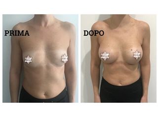 Mastoplastica additiva prima e dopo