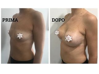 Mastoplastica additiva prima e dopo