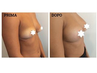 Mastoplastica additiva prima e dopo