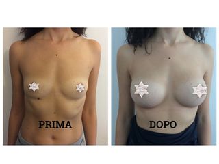 Mastoplastica additiva prima e dopo