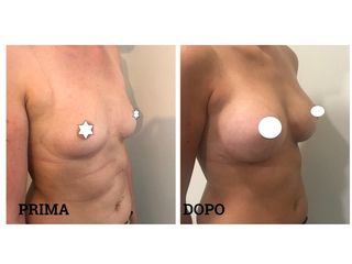 Mastoplastica additiva pre e post
