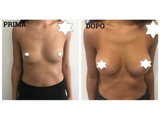Mastoplastica additiva prima e dopo