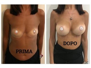 Mastoplastica additiva prima e dopo