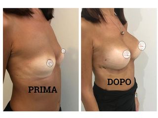 Mastoplastica additiva prima e dopo