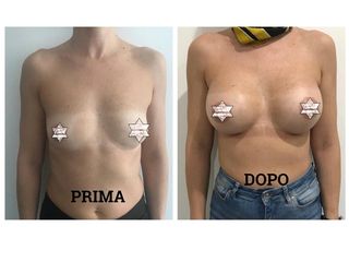 Mastoplastica per aumento del seno