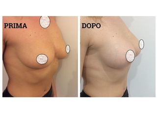 Mastoplastica additiva prima e dopo