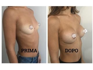 Mastoplastica additiva prima e dopo