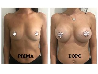 Mastoplastica additiva prima e dopo