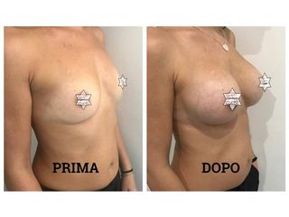 Mastoplastica additiva prima e dopo