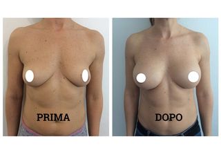 Mastoplastica additiva prima e dopo