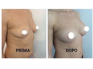 Mastoplastica additiva prima e dopo