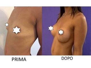 Mastoplastica additiva - Medicalcenter- Olbia