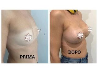 Mastoplastica additiva - Medicalcenter- Olbia