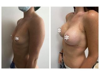Mastoplastica additiva - Medicalcenter- Olbia