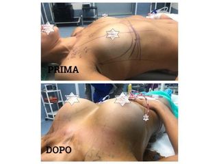 Mastoplastica additiva - Medicalcenter- Olbia