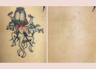Tatuaggio prima e dopo
