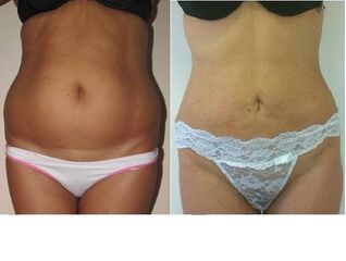 liposcultura addome prima e dopo