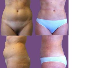 Liposcultura prima e dopo