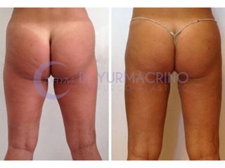 Liposuzione prima e dopo