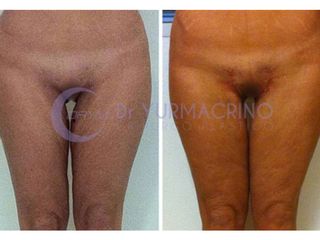 lifting interno coscia prima e dopo