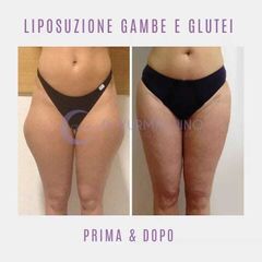 Liposuzione - Dott. Yuri Macrino