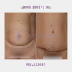 Addominoplastica - Dott. Yuri Macrino