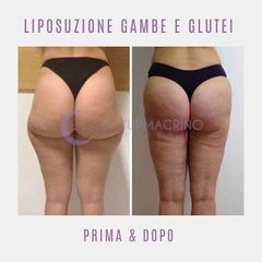 Liposuzione - Dott. Yuri Macrino