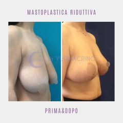Mastoplastica riduttiva - Dott. Yuri Macrino