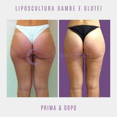 Liposuzione - Dott. Yuri Macrino