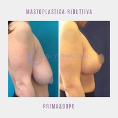 Mastoplastica riduttiva - Dott. Yuri Macrino