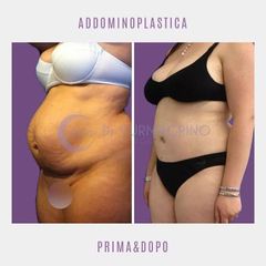 Addominoplastica - Dott. Yuri Macrino