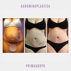 Addominoplastica - Dott. Yuri Macrino