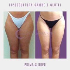 Liposuzione - Dott. Yuri Macrino