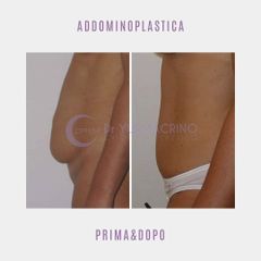 Addominoplastica - Dott. Yuri Macrino