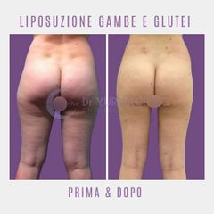 Liposuzione - Dott. Yuri Macrino