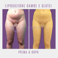 Liposuzione - Dott. Yuri Macrino