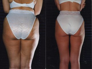 liposcultura prima dopo