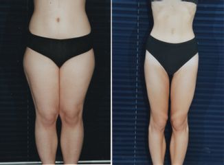 liposcultura prima dopo