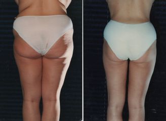 liposcultura prima dopo