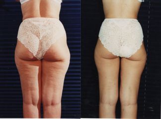 Cellulite prima dopo