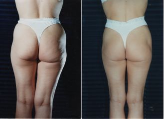 Cellulite prima dopo