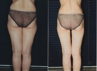 liposcultura prima dopo