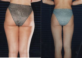 liposcultura prima dopo