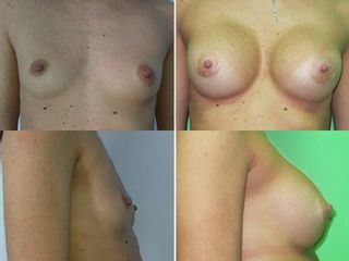 mastoplastica additiva prima dopo