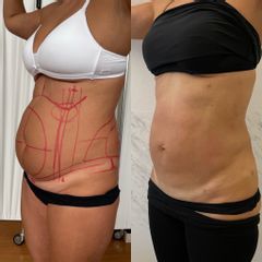 Liposuzione  - Dr Luca Zattoni